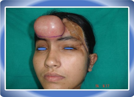 TISSUE EXPANDER